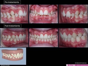 Tratamiento ortodoncia. Técnica Invisalign