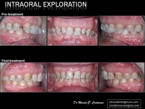 intraoral-exploration-post-treatment