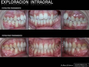 intraoral